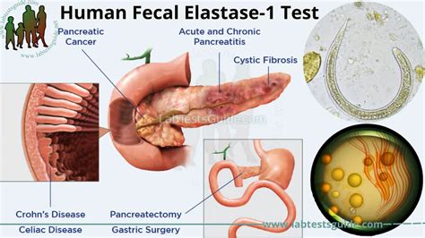 Elastaza pancreatică în materii fecale